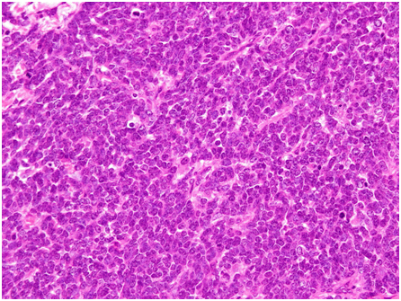 Small cell carcinoma 
